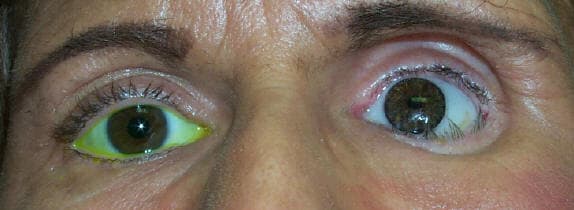 Superior sulcus hollowing from volume loss