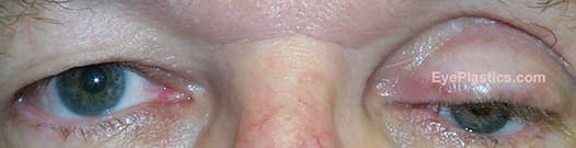 Deep superior sulcus after enucleation