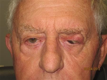 Exposed orbital implant requiring surgical repair
