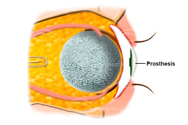 Custom-painted ocular prosthesis