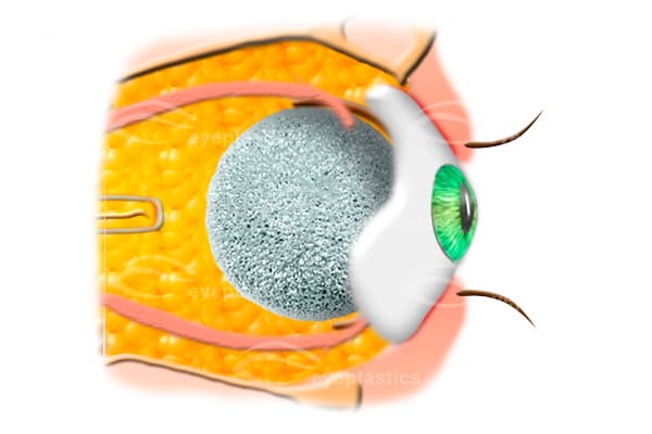 Fitted ocular prosthesis in the socket