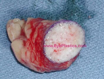 Dermis-fat graft harvested for socket reconstruction