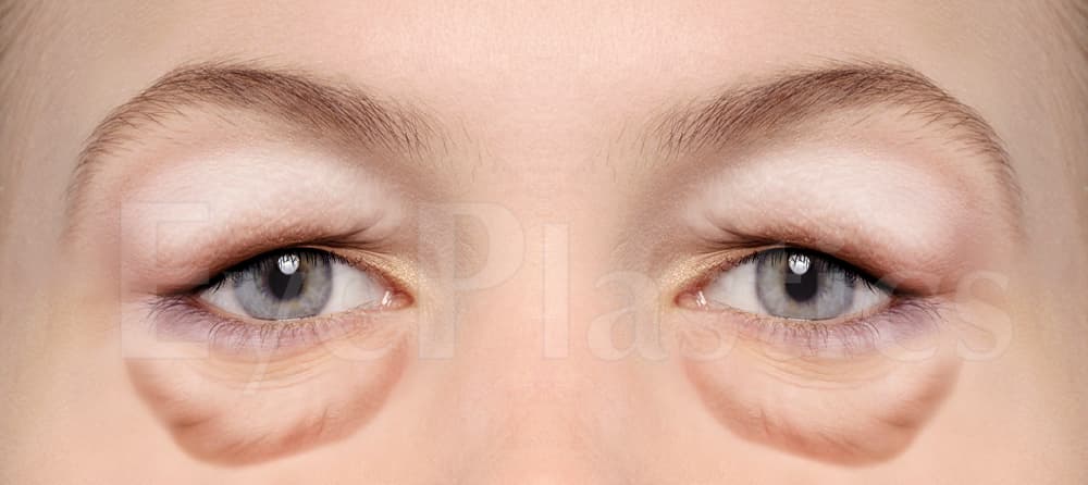 Four-lid (combined upper and lower) blepharoplasty before and after