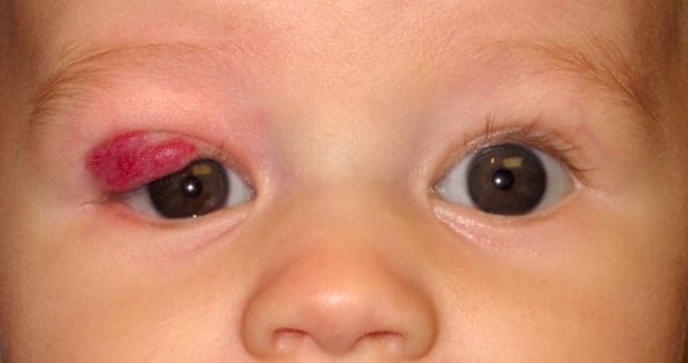 Marked fading of the hemangioma at four months of timolol