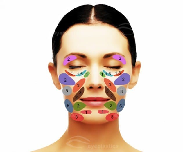 Periorbital areas marked for fat transfer