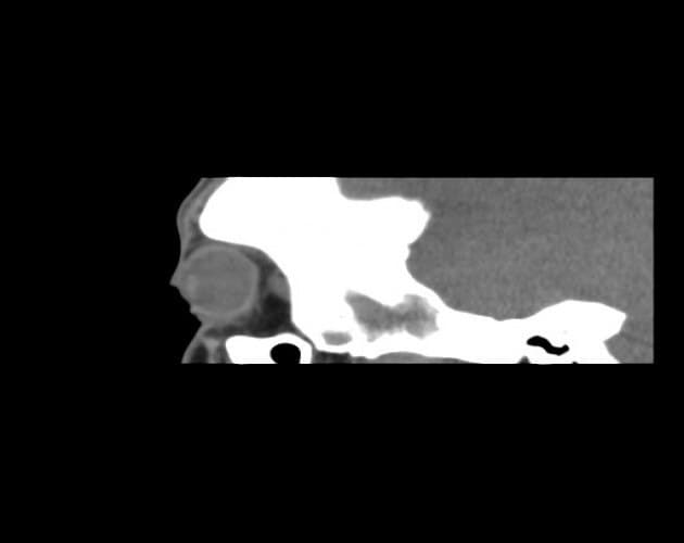 CT — ground-glass expansion of orbital bone characteristic of fibrous dysplasia