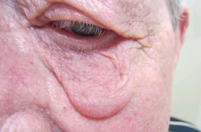 Rosacea — facial presentation