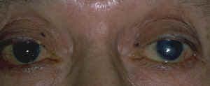 Cutaneous melanoma with asymmetry, irregular border, and color variation