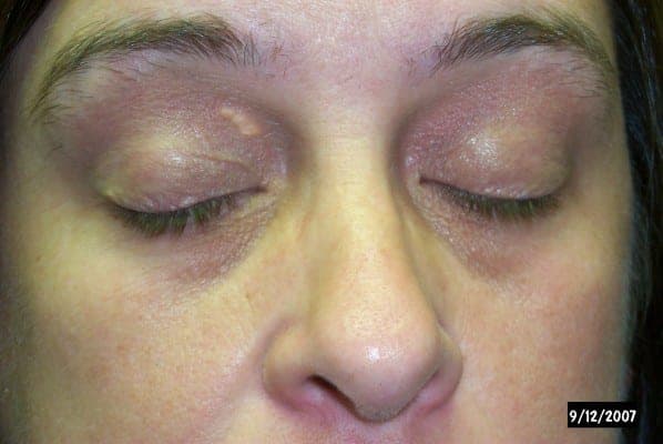 Xanthelasma — soft yellow cholesterol plaques on the eyelids