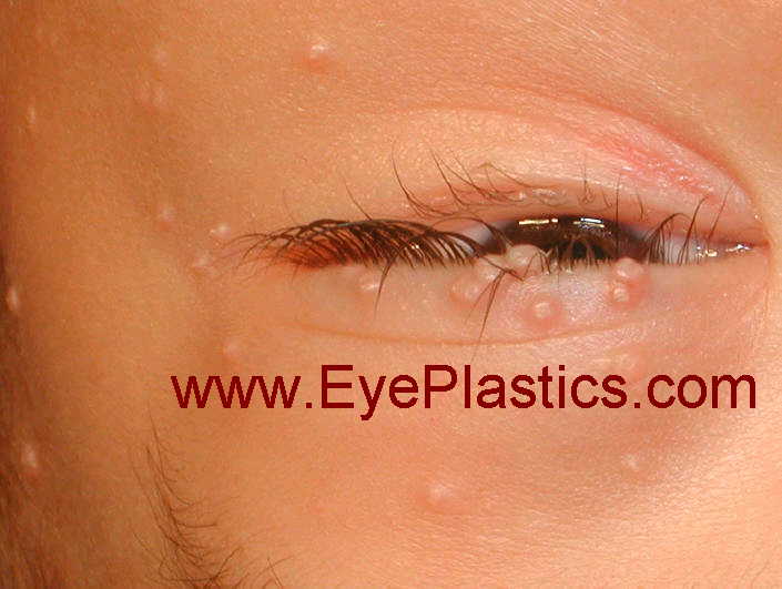 Molluscum contagiosum lesions on the eyelid