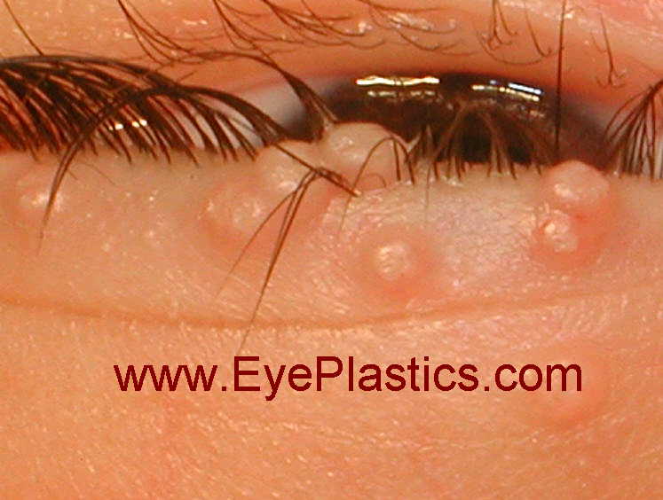 Molluscum contagiosum — close-up of eyelid papules