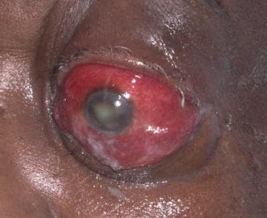 Orbital cellulitis — periorbital swelling, erythema, and proptosis