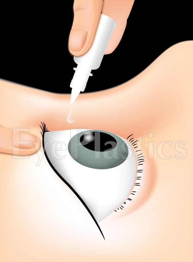 Instilling 2.5% phenylephrine (Neo-Synephrine) drops to test Müller's-muscle response in ptosis