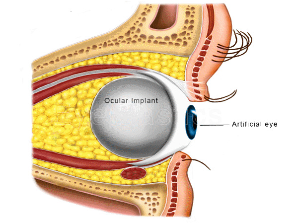 Prosthetic eye motility demonstration
