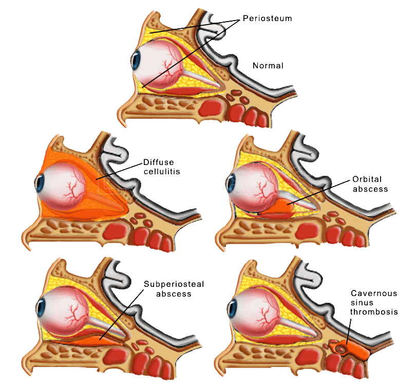 Diagram of the orbital septum separating preseptal from orbital tissue