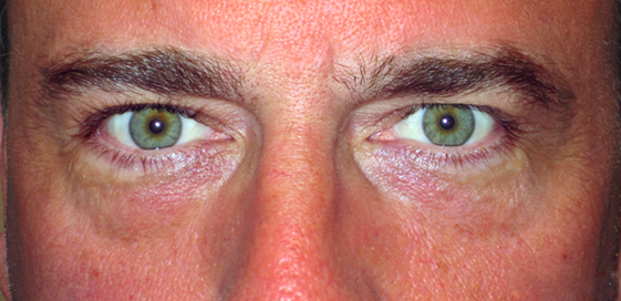 Patient 1 — after